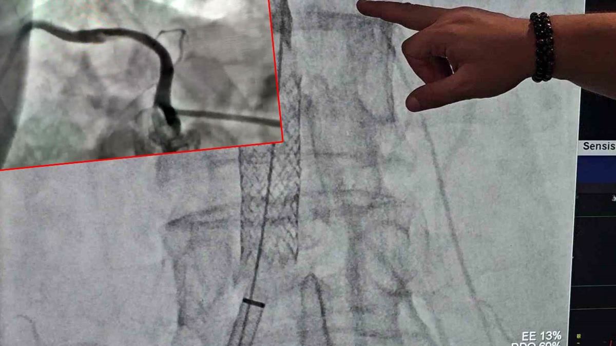 Zonguldak'ta şiddetli öksürük 52 yaşındaki kadının kalp damarını yırttı: Ereğli'de doktorlar kadını nasıl kurt